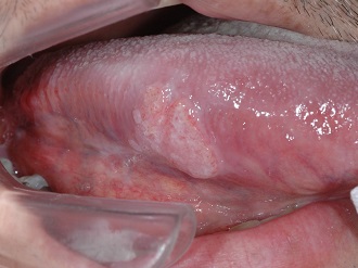 舌の口内炎と舌癌はどう違うのか？