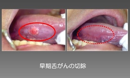 早期舌癌の切除