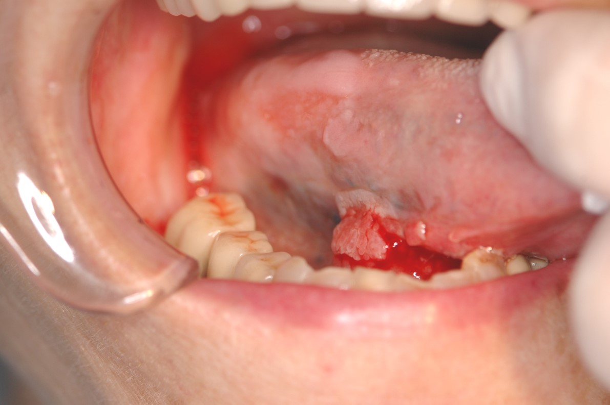 どこかわからないが、出血する