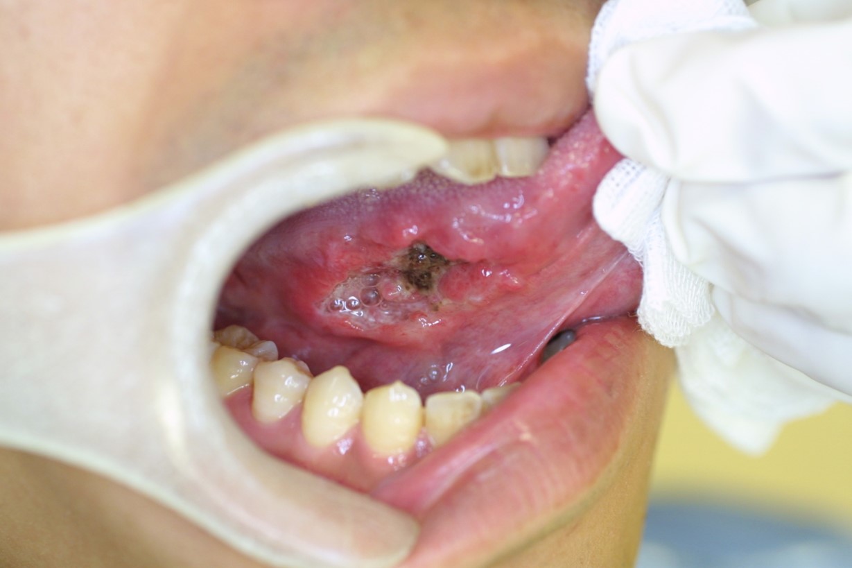 どこかわからないが、出血する