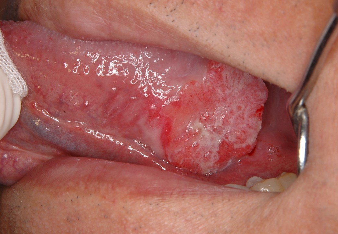 口の中のどこかに「しこり」や「はれ」肥大した部分がある
