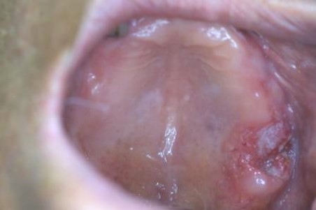 顎（あご）が腫れて義歯（入れ歯）が合わなくなったり、違和感（変な感じ）がある