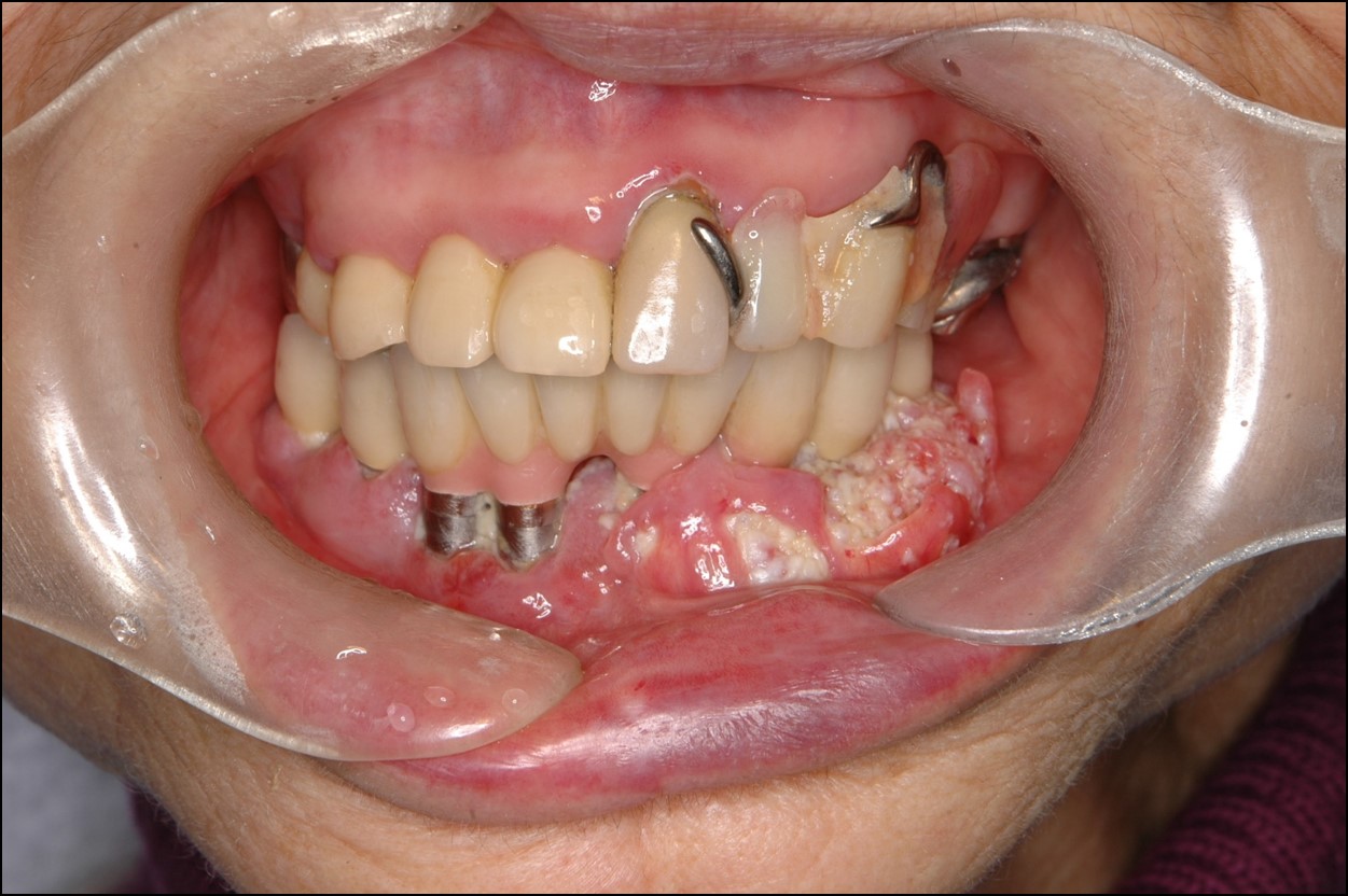 舌がんだけじゃない！口腔がんの初期症状と早期発見のための対策 | 歯のアンテナ