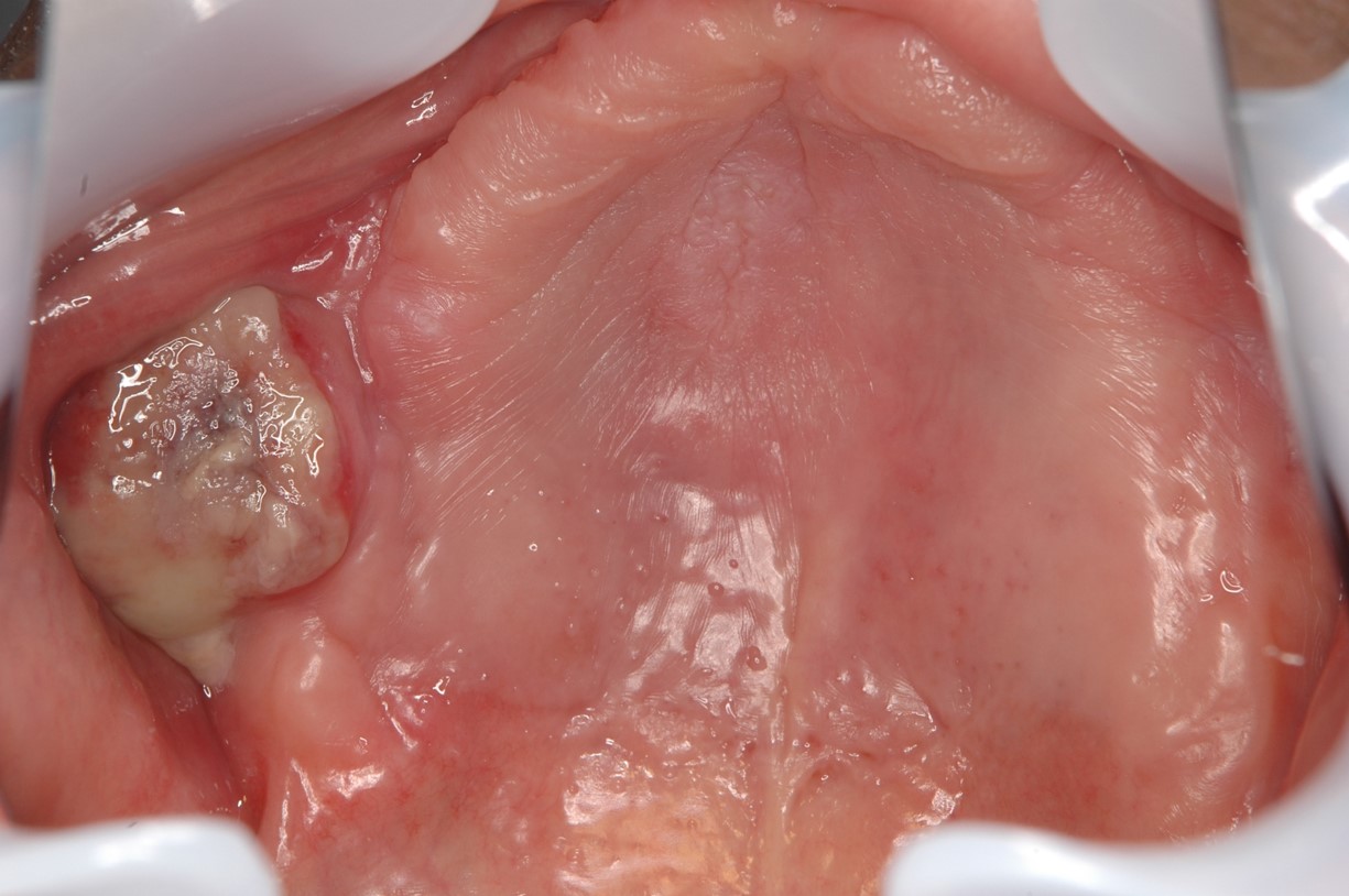 鼻の片側だけに鼻詰まりがある