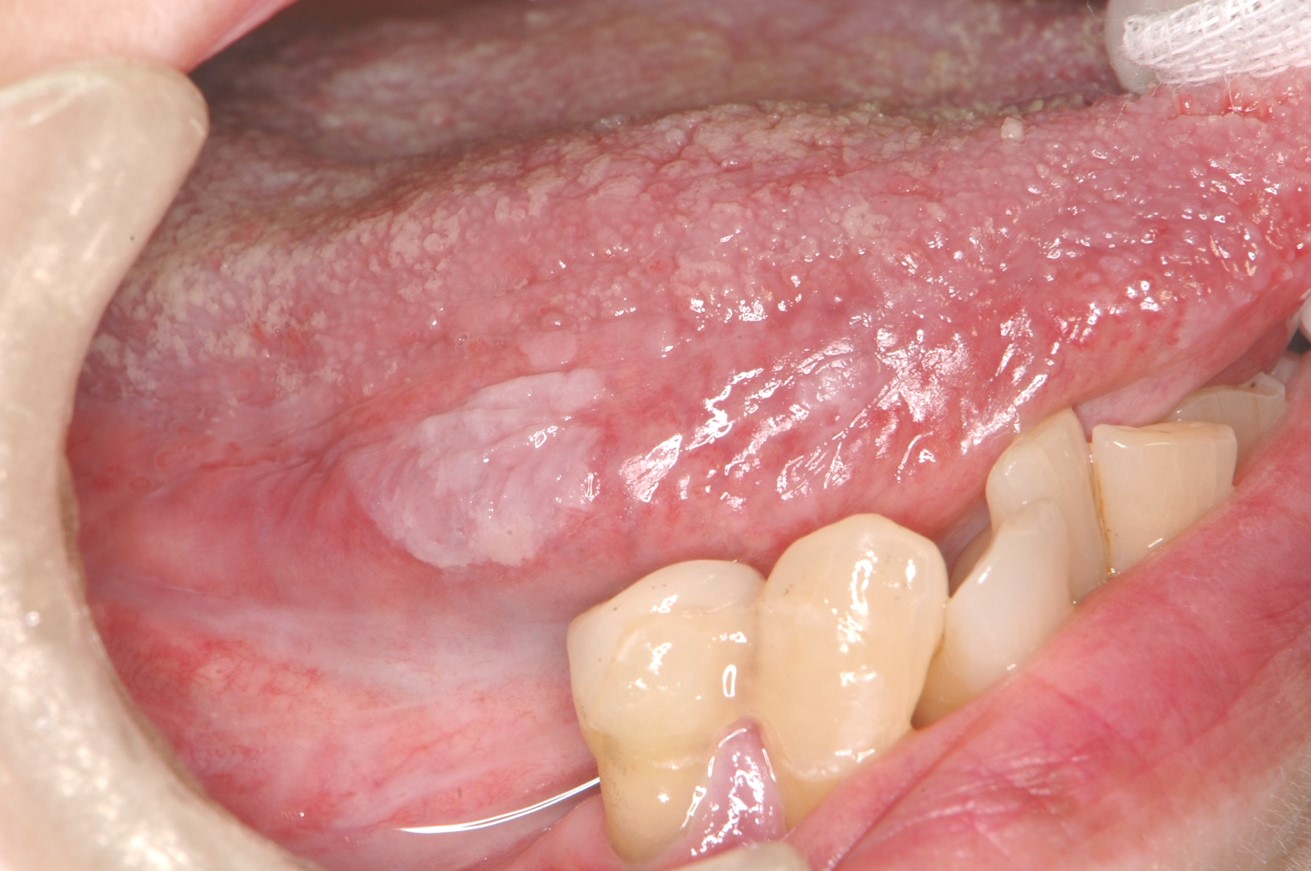 舌癌与非舌癌的图片比较 - 好大夫在线