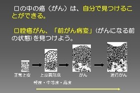 口腔癌の現状