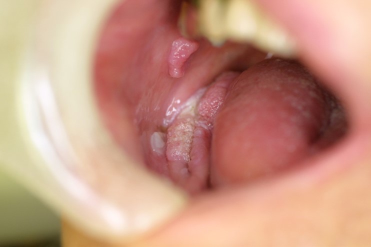 の 中 ない 口 痛く でき もの 口の中の「透明なできもの」の正体。痛い・痛くないのは？潰すのはNG！【粘液嚢胞・ヘルペス】