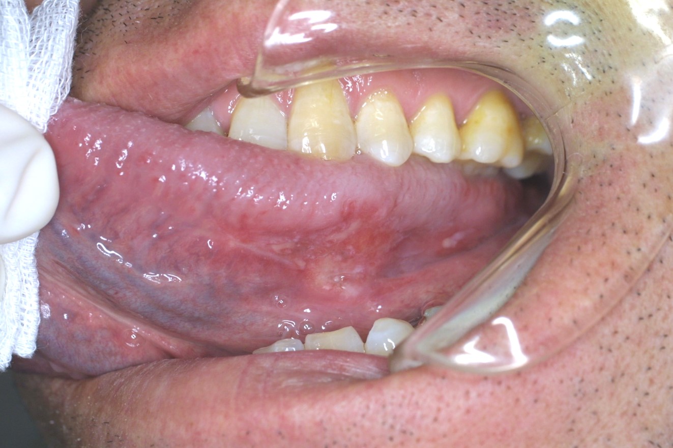口腔・舌病変をみる-初期病変も見逃さないポイント- (MB ENTONI(エントーニ))