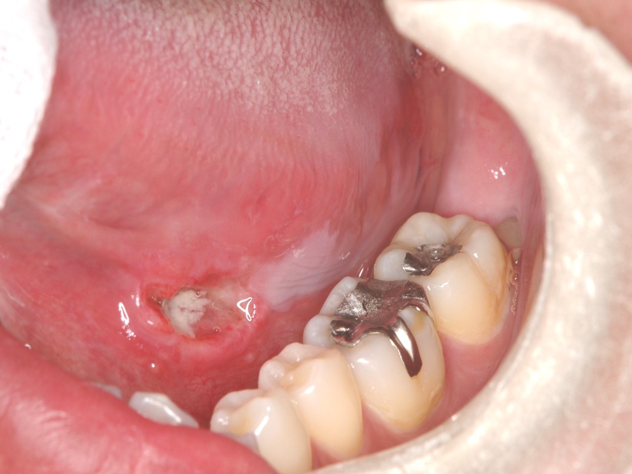 口腔癌 歯茎