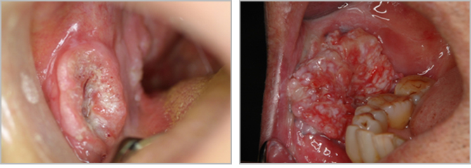 頬粘膜がん2